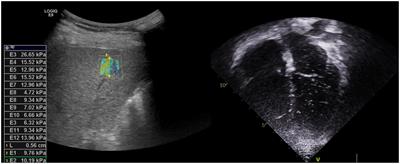 Hepatopulmonary syndrome secondary to metabolic associated fatty liver disease in childhood — novel treatment with growth hormone replacement therapy: a case report and systematic review of literature